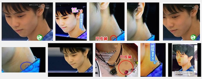 Yuzuru Hanyu with press needles